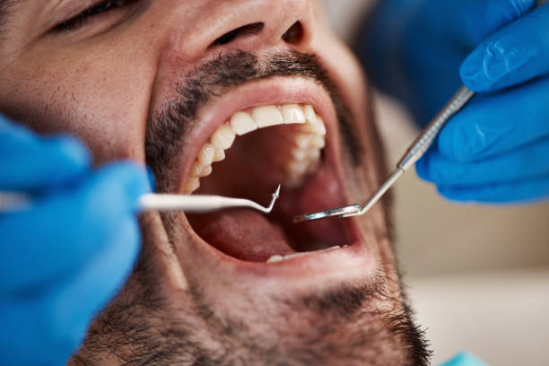 Best Emergency Treatment for Dental Infections or Abscesses in Lakeland, NY