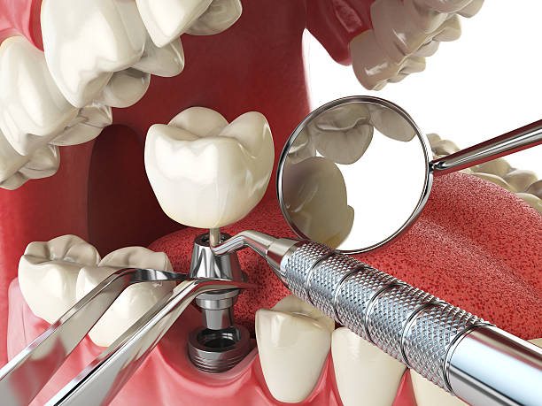 Best Emergency Treatment for Dental Infections or Abscesses in Lakeland, NY